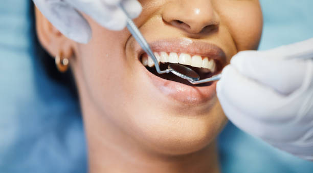 Best Emergency Wisdom Tooth Extraction in Cassville, WV