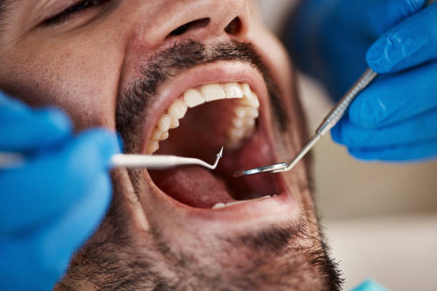 Best Emergency Dental Care for Sports Injuries in Cassville, WV